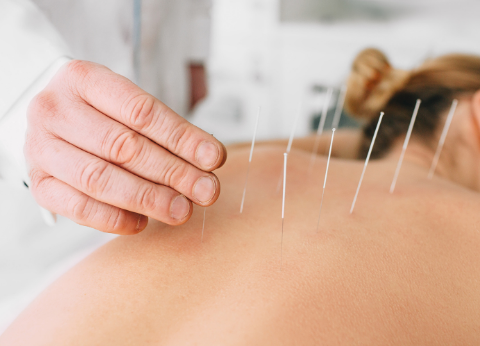 Dry Needling​